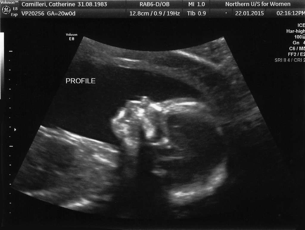 20 weeks baby scan